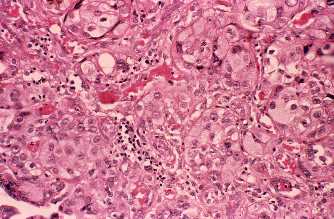Oesophagus cancer,light micrograph