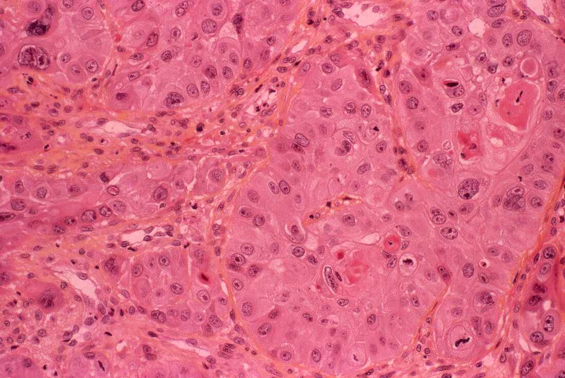 Oesophagus cancer,light micrograph