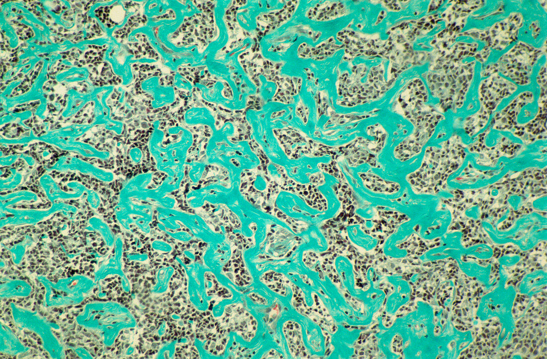 Light micrograph of a human lymphoma