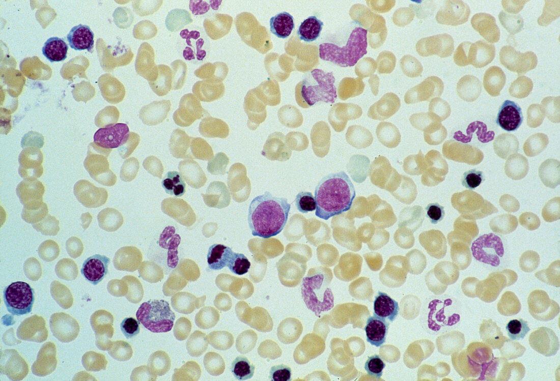 LM of bone marrow from chronic leukaemic patient