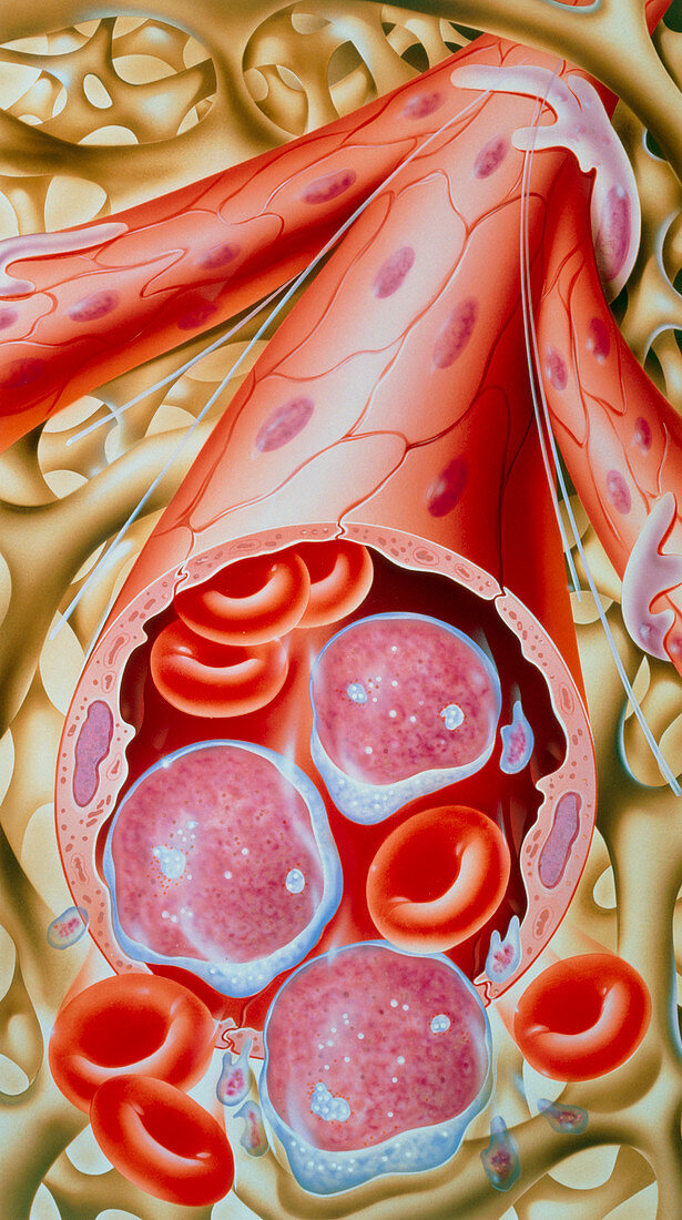 Illustration of chronic myeloid leukaemia