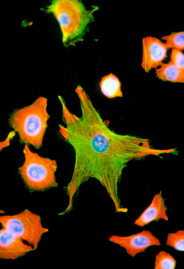LM of melanoma cancer cells