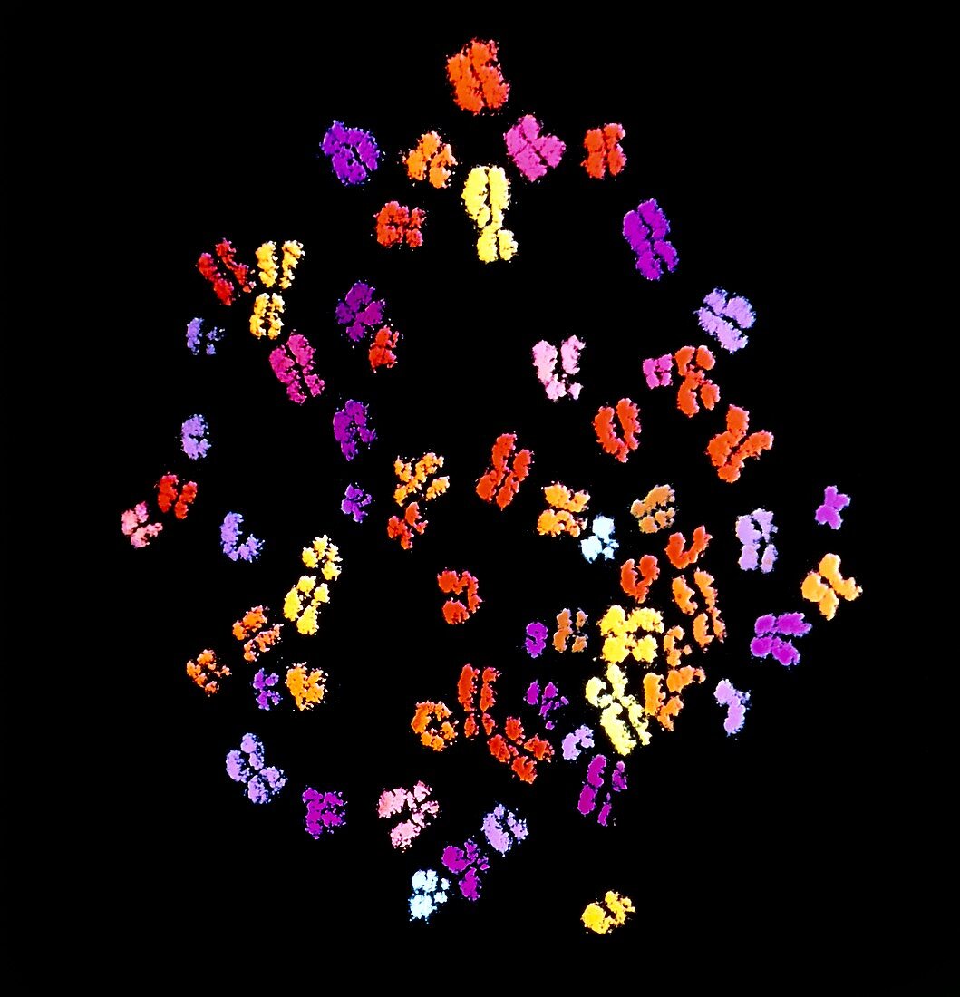 Coloured SEM of chromosomes of bone cancer patient