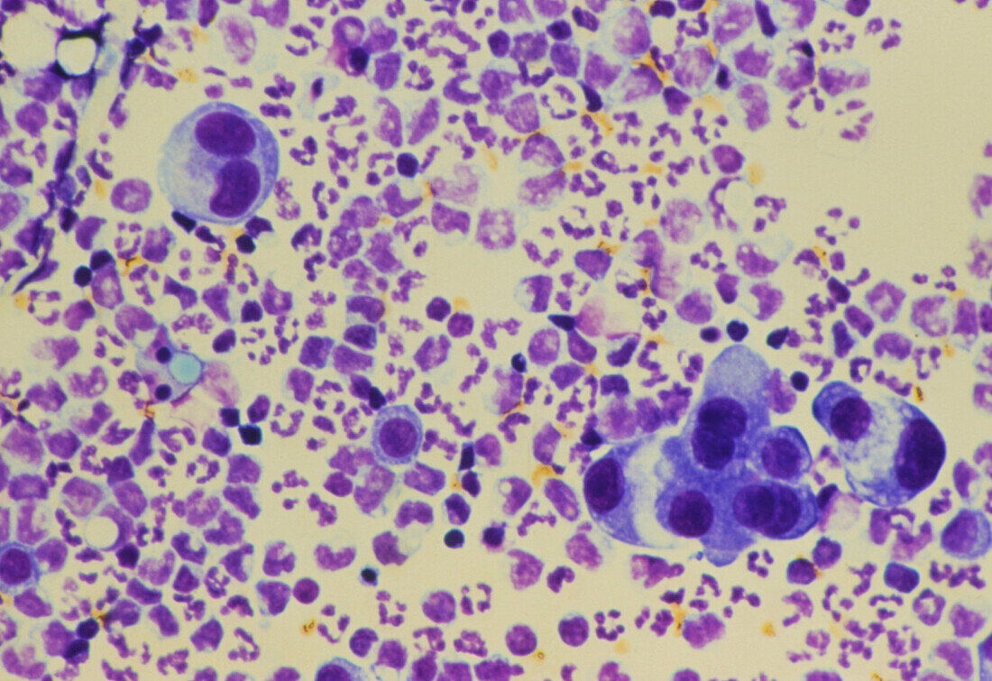 LM of cancerous glandular cells in ascitic fluid
