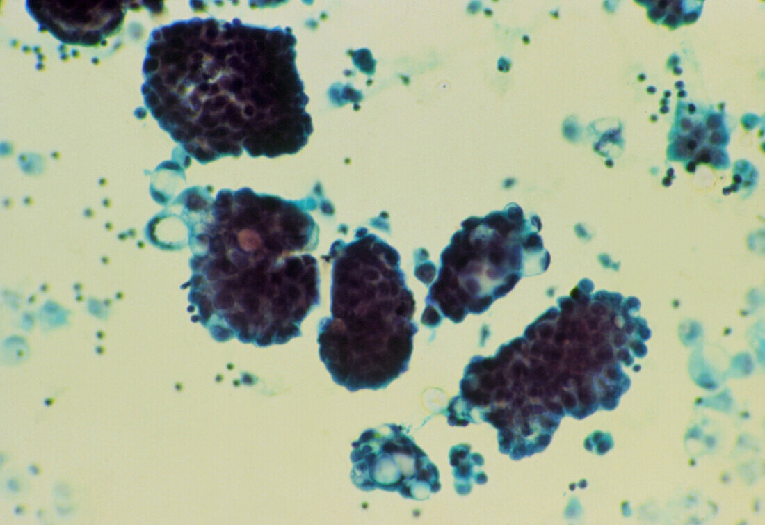 LM of cancerous glandular cells in ascitic fluid