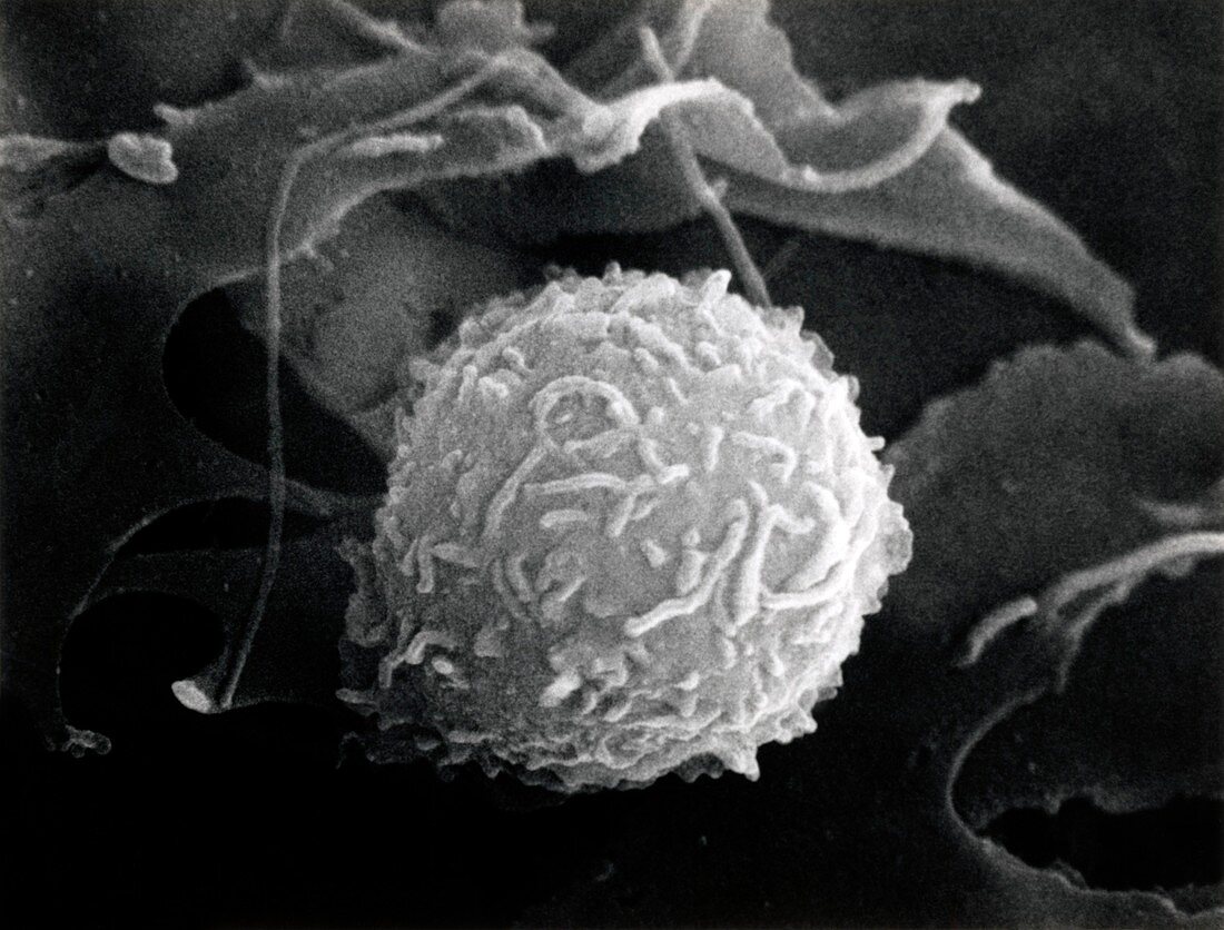 SEM showing a leukaemic lymphoblast