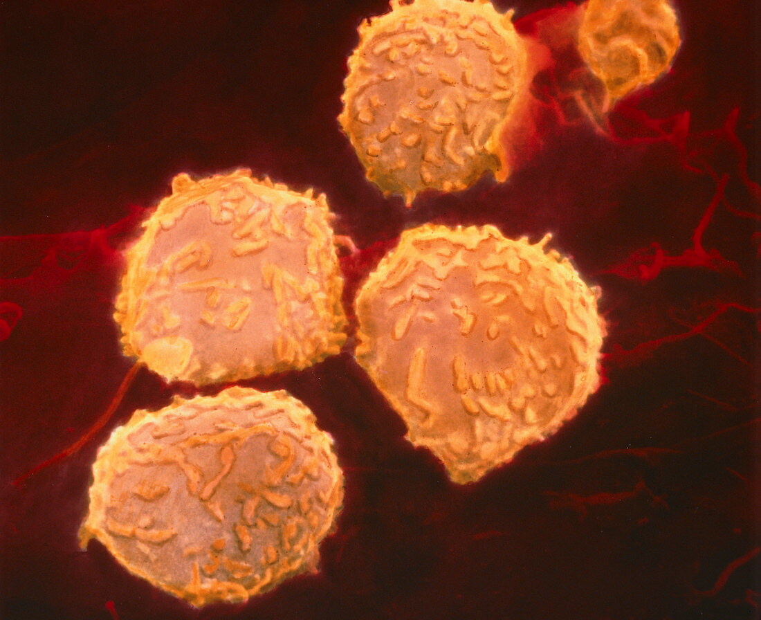 Coloured SEM of human leukaemic lymphoblasts