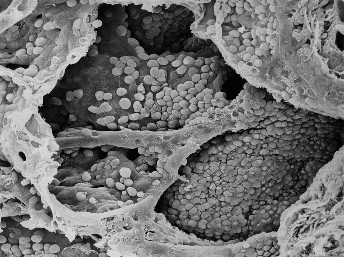 Cancer cells inside alveoli (air sacs) in the lung