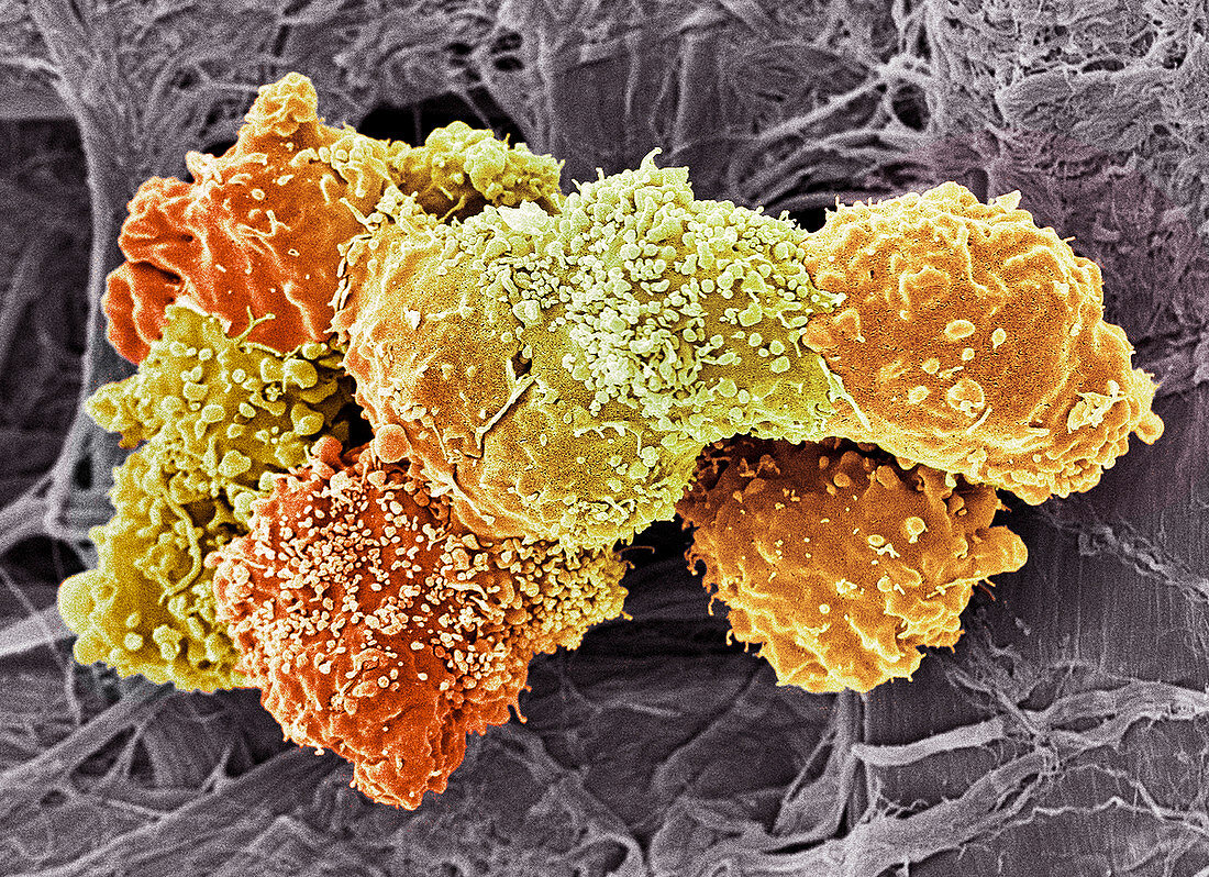 Teratoma cancer cells,SEM