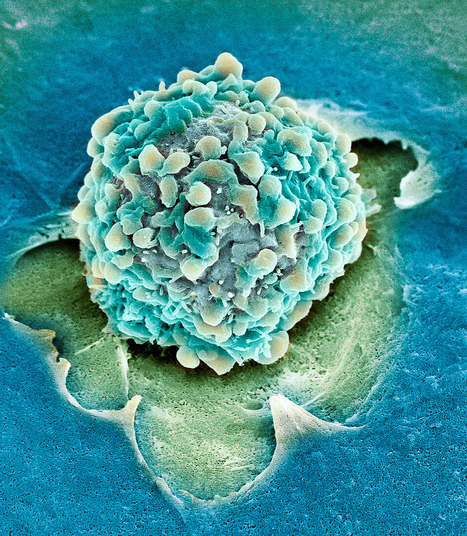 Rectal cancer cell,SEM