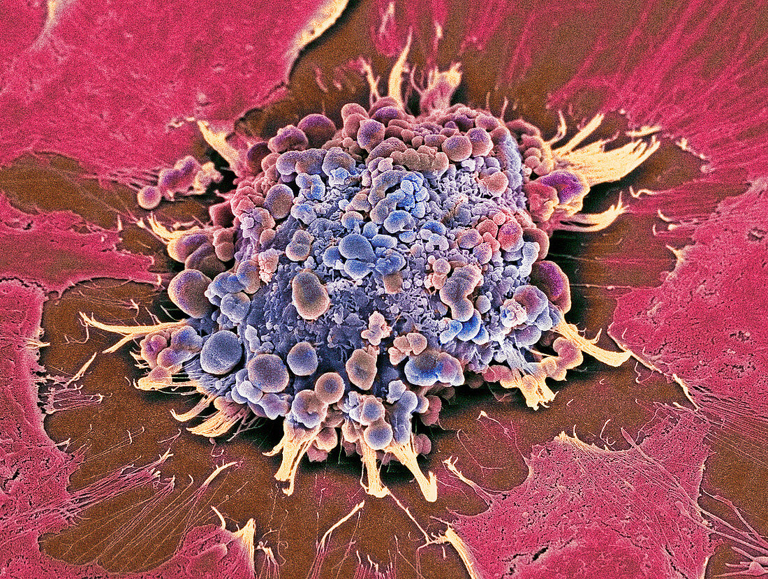 Cancer cell apoptosis,SEM