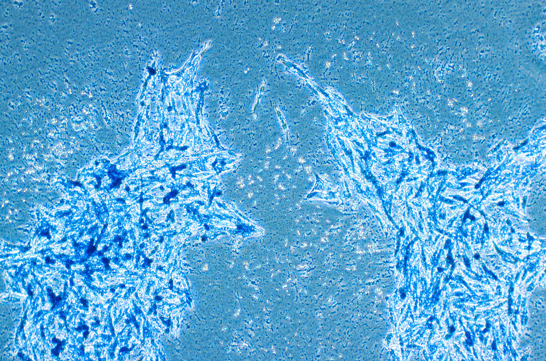 Skin cancer cells,light micrograph