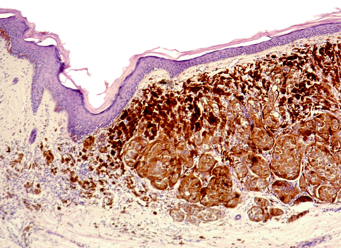 Skin cancer,light micrograph