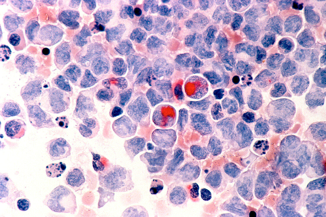 Leukaemia blood cells,light micrograph