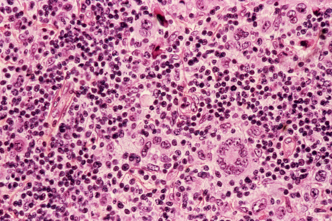 Hodgkin's disease,light micrograph