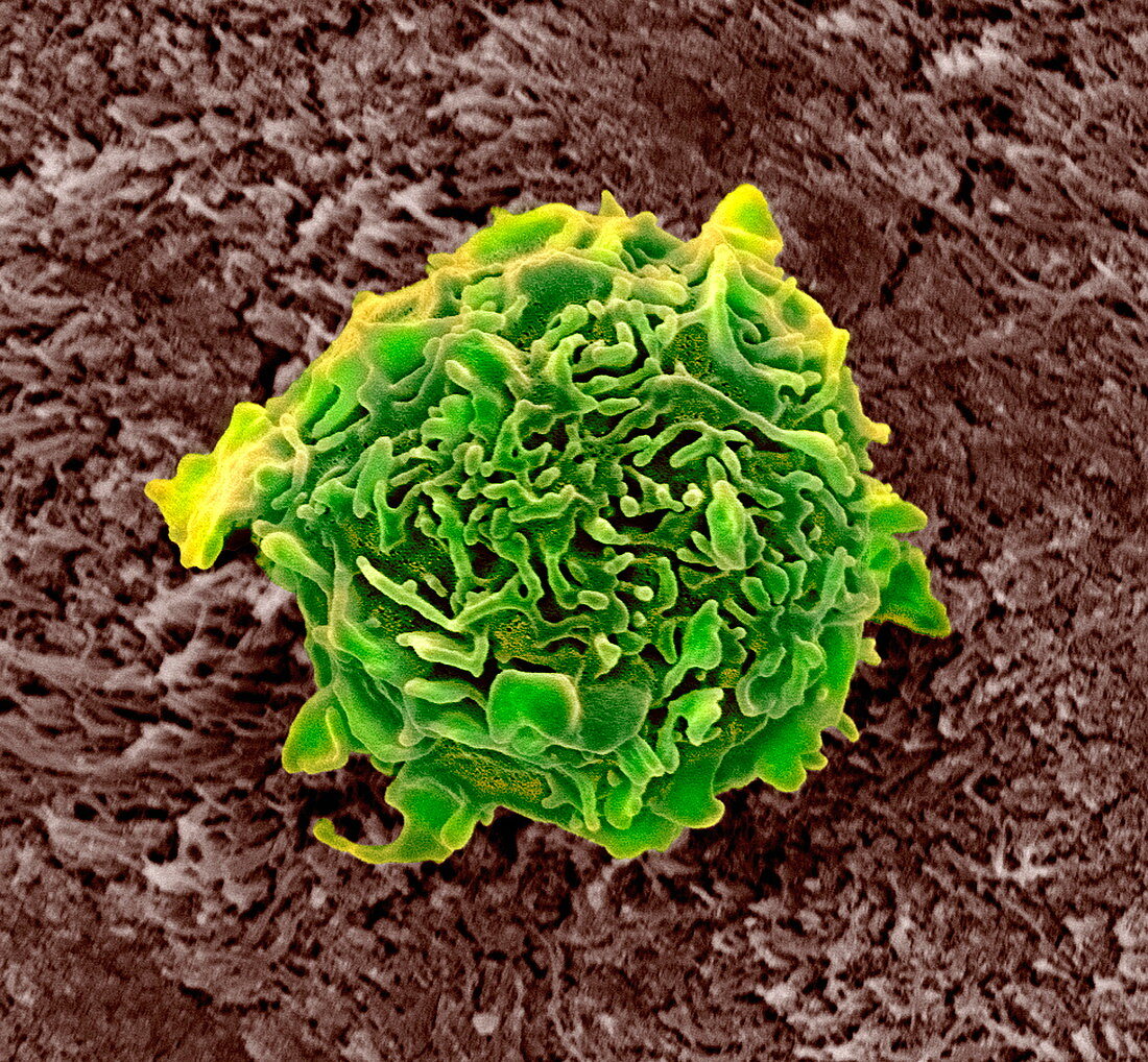 Bone cancer cell,SEM