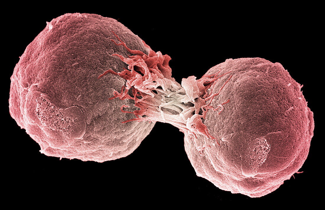 Dividing lymphoma cancer cells,SEM