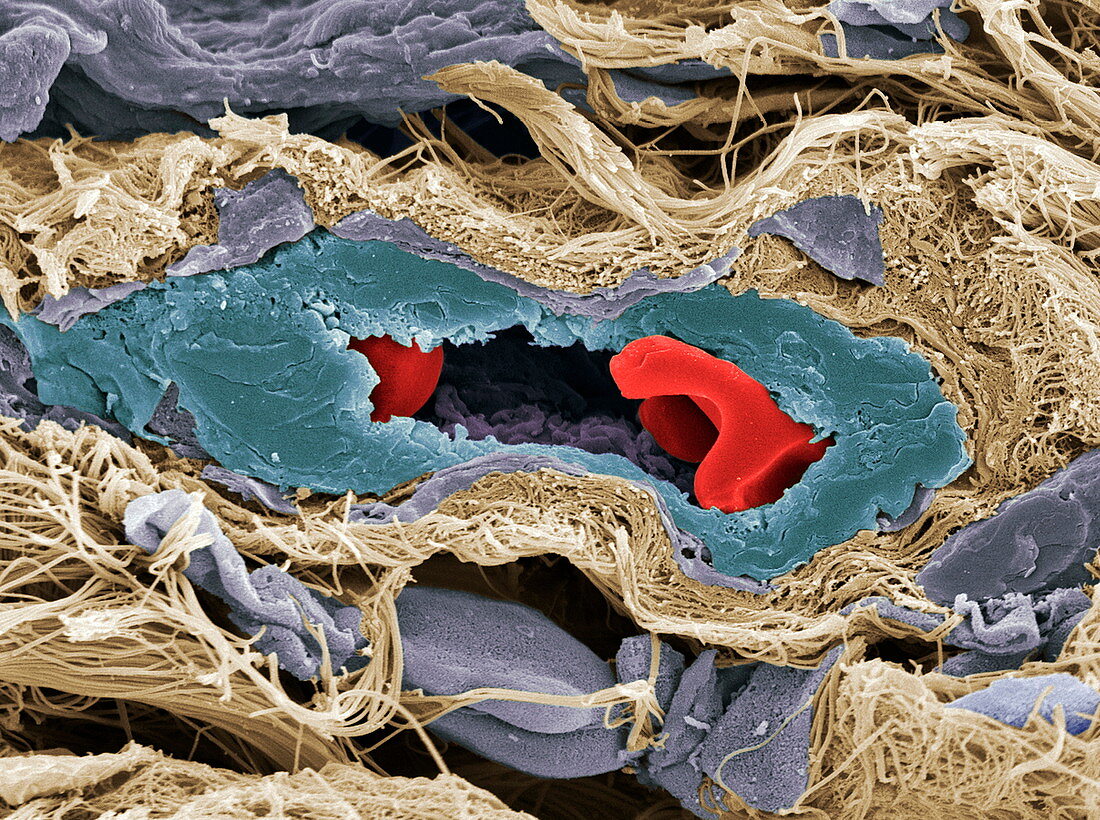 Tumour,SEM