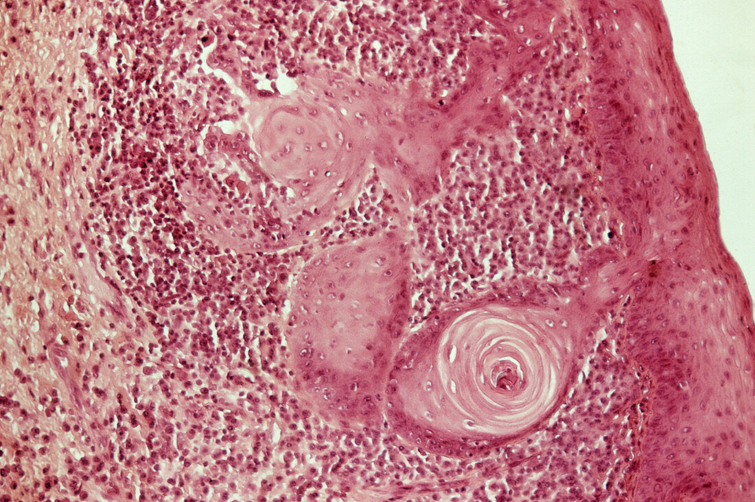 Laryngeal cancer,light micrograph