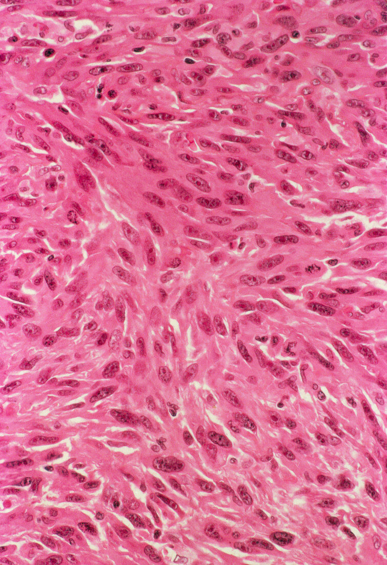 Fibrosarcoma,light micrograph