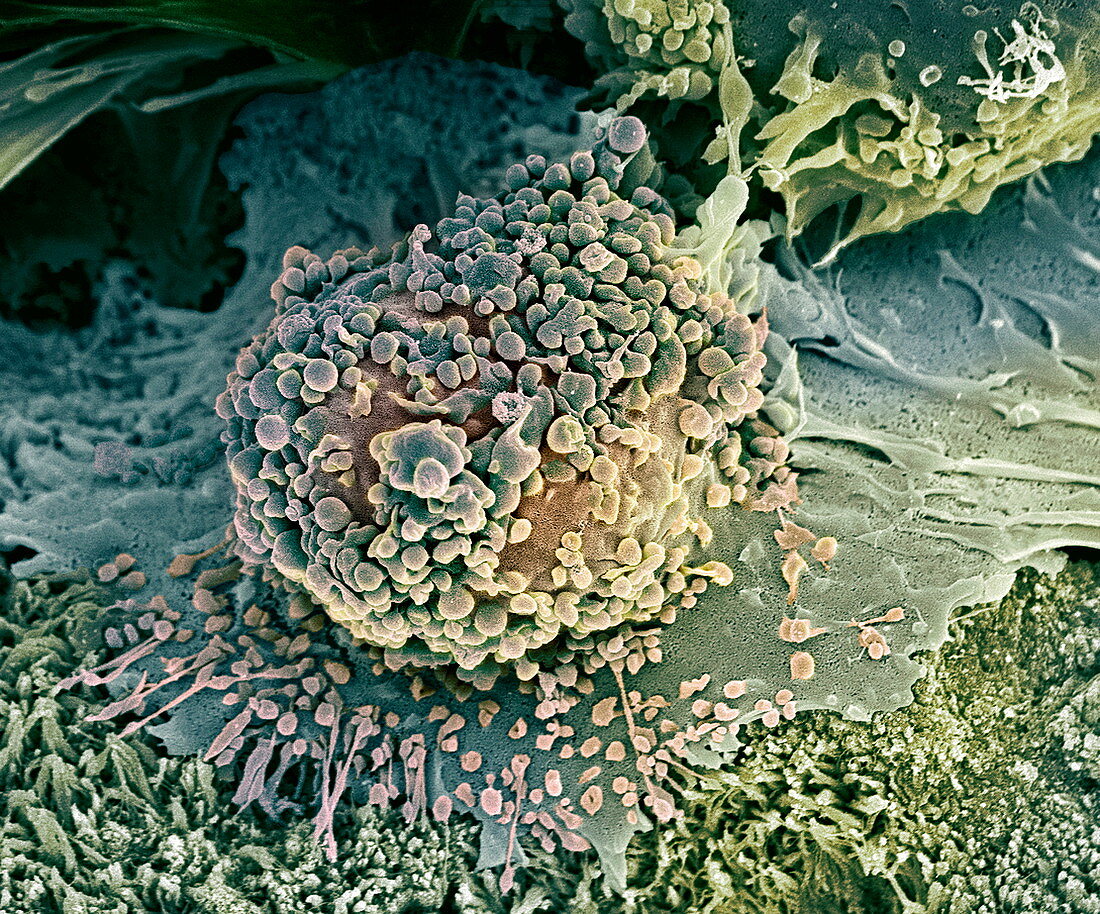 Bone cancer cell,SEM