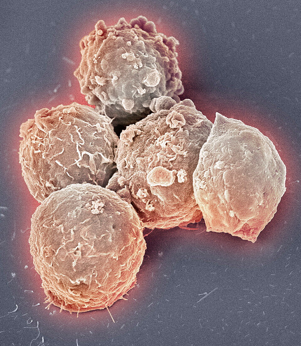 Blood cancer cells,SEM