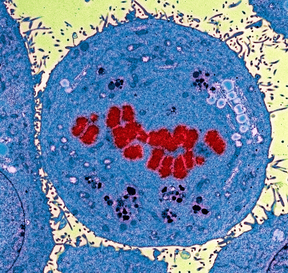 Dividing carcinoma cell,TEM