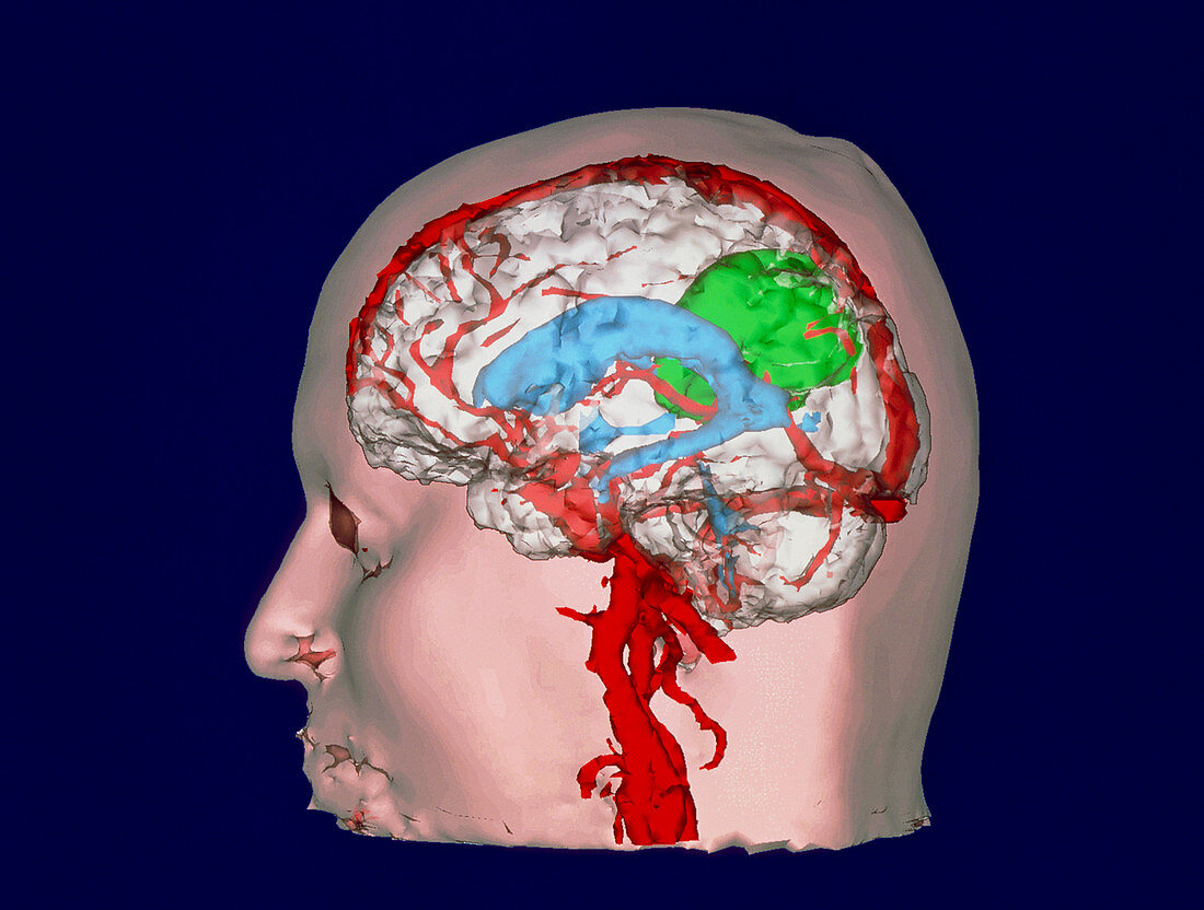 3-D MRI scan of a brain with tumour