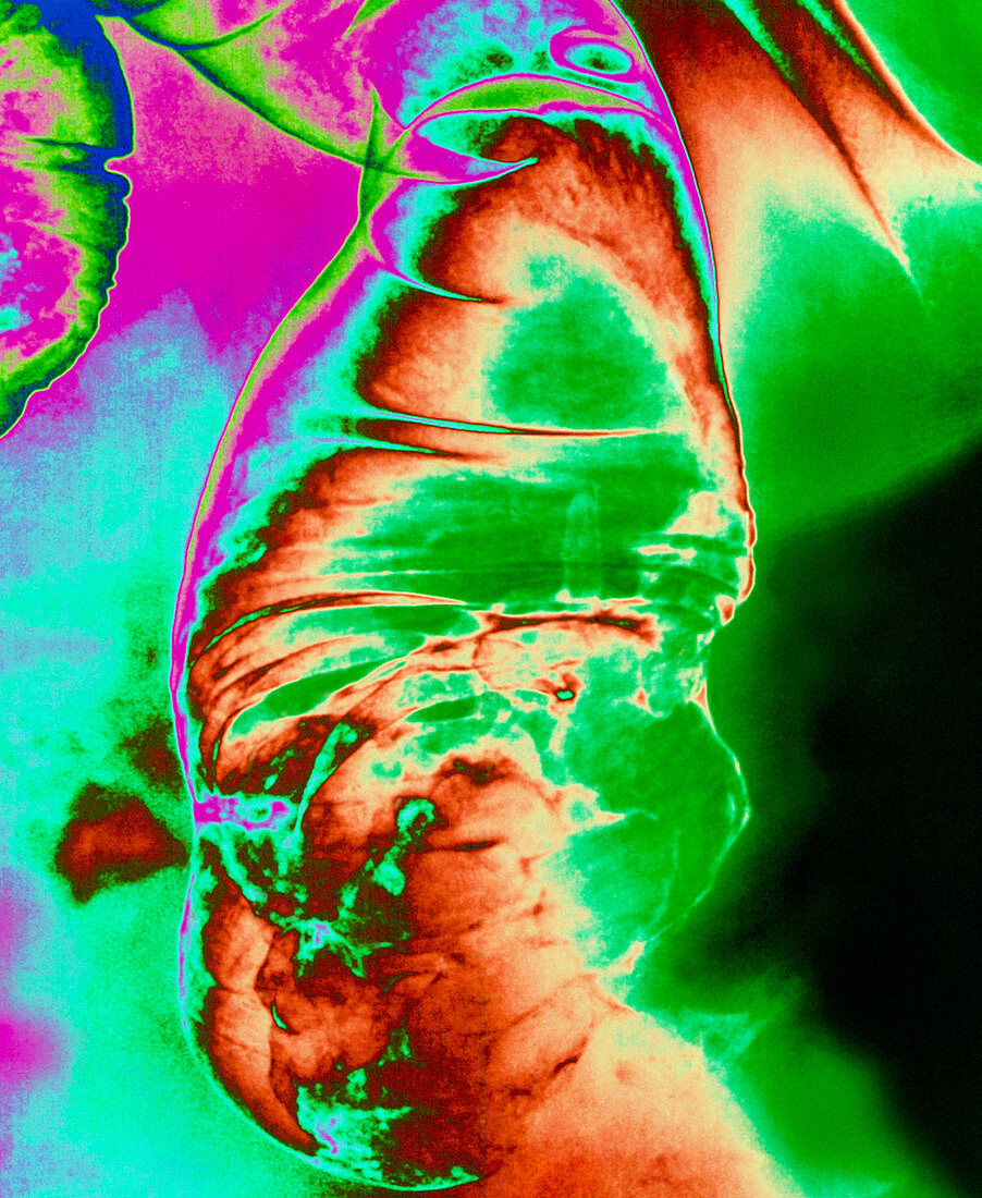 Coloured barium X-ray showing cancer of the colon