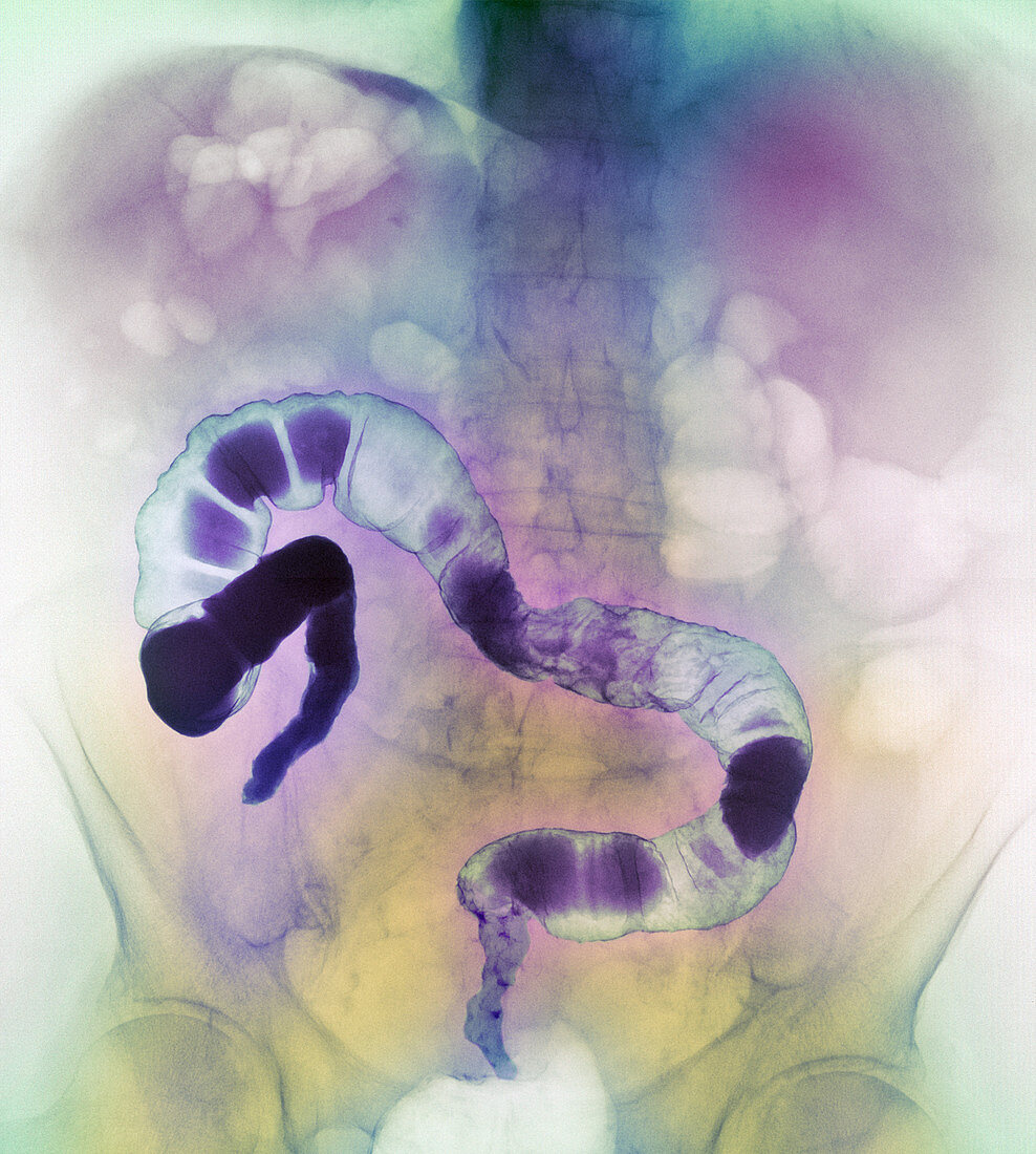 Coloured X-ray of the colon showing rectal cancer