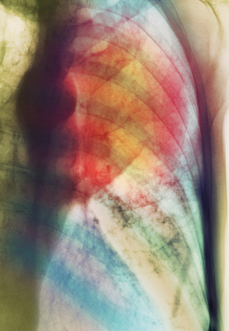 Lung cancer X-ray