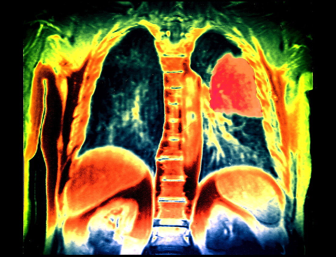 Lung cancer,MRI