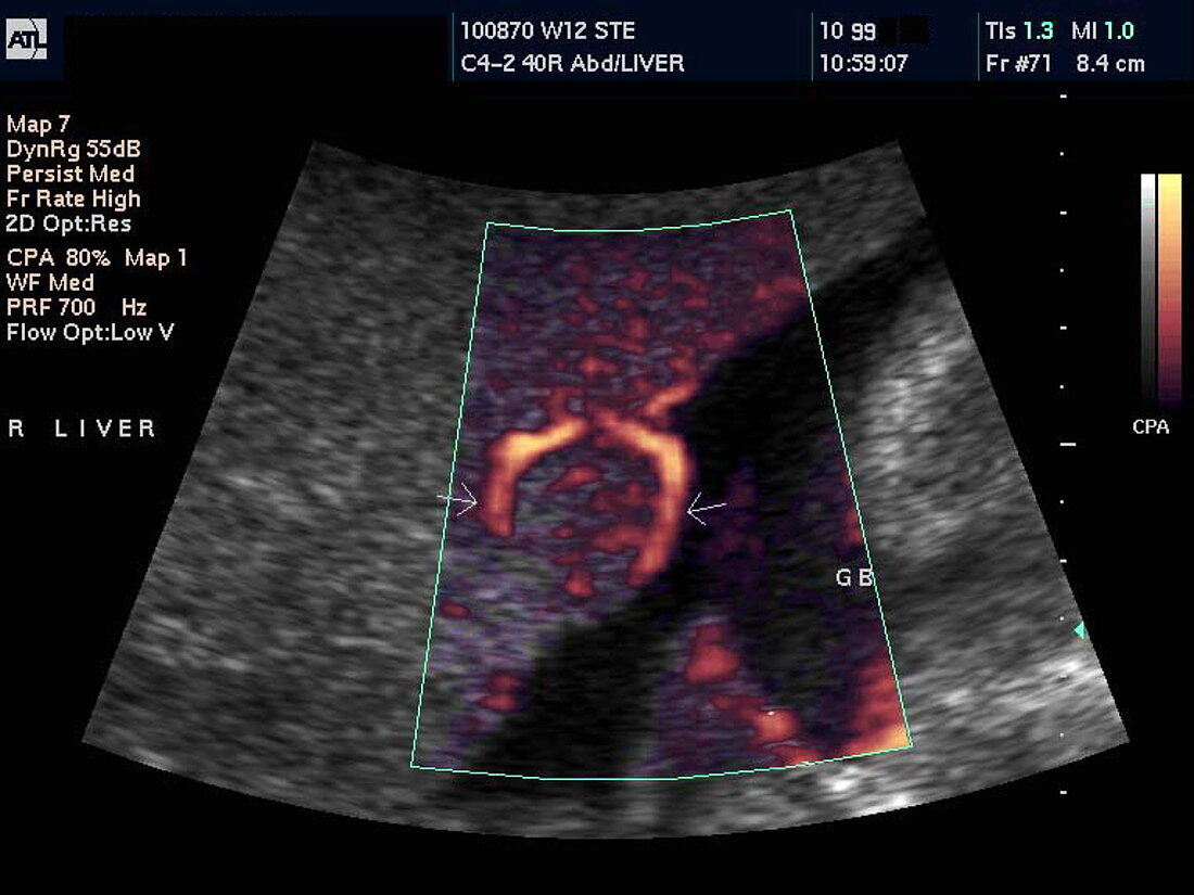 Liver cancer,Doppler ultrasound