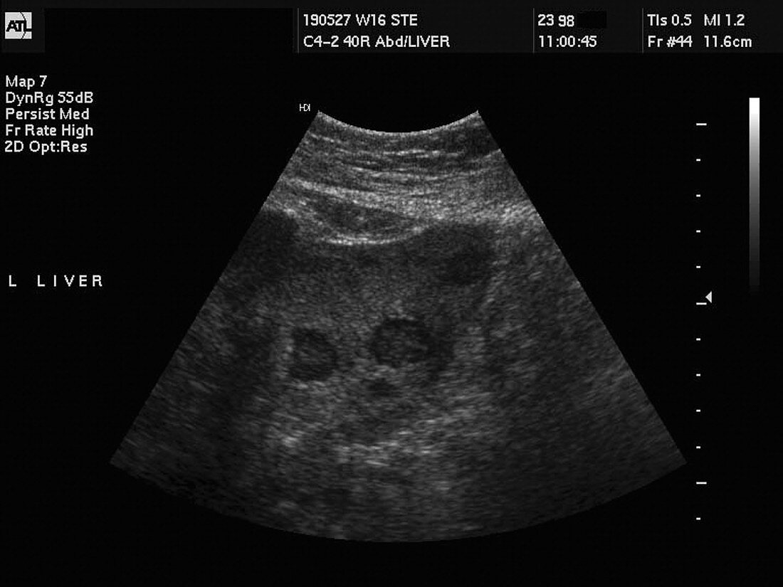 Liver cancer,ultrasound