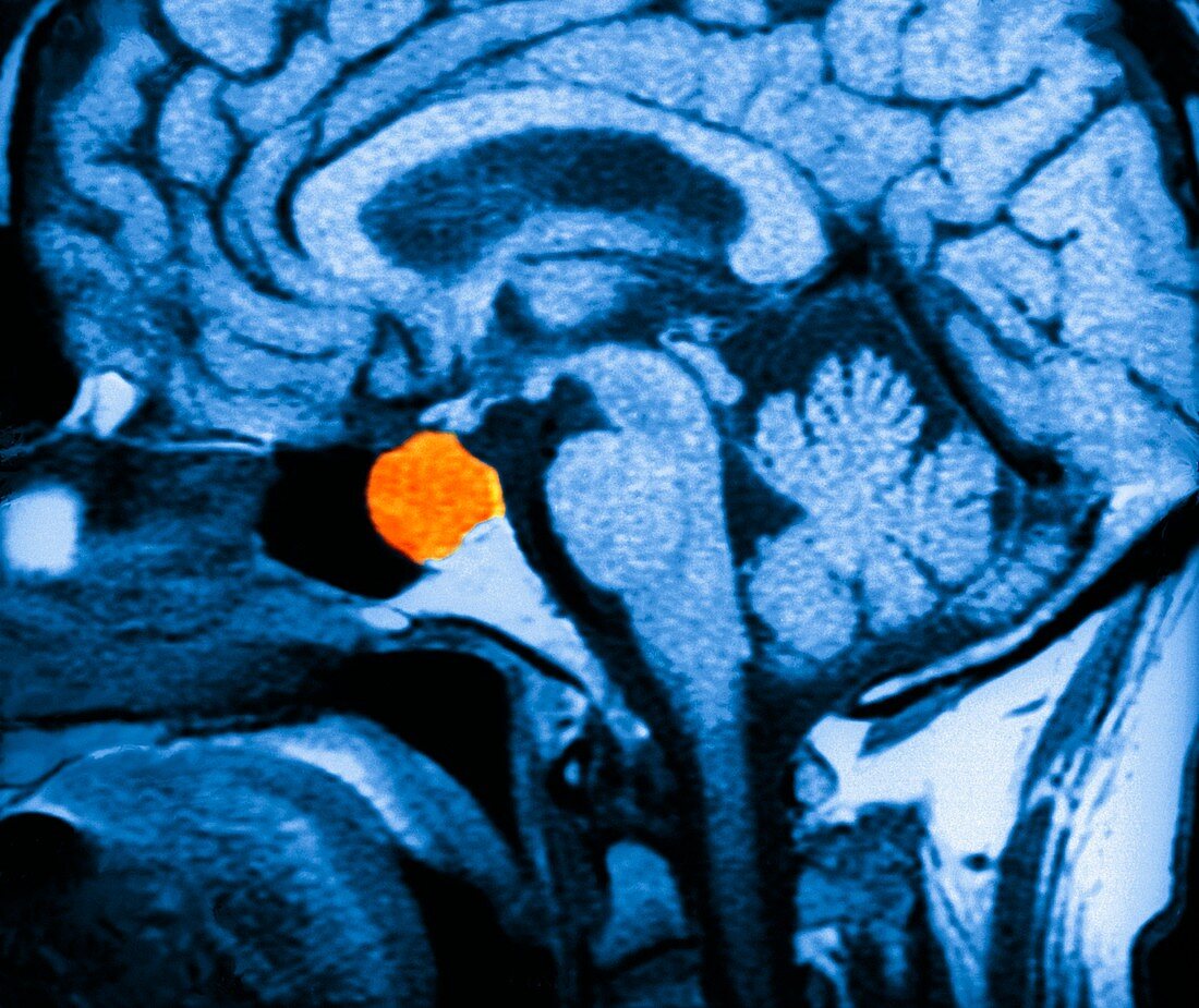 Brain tumour,CT scan