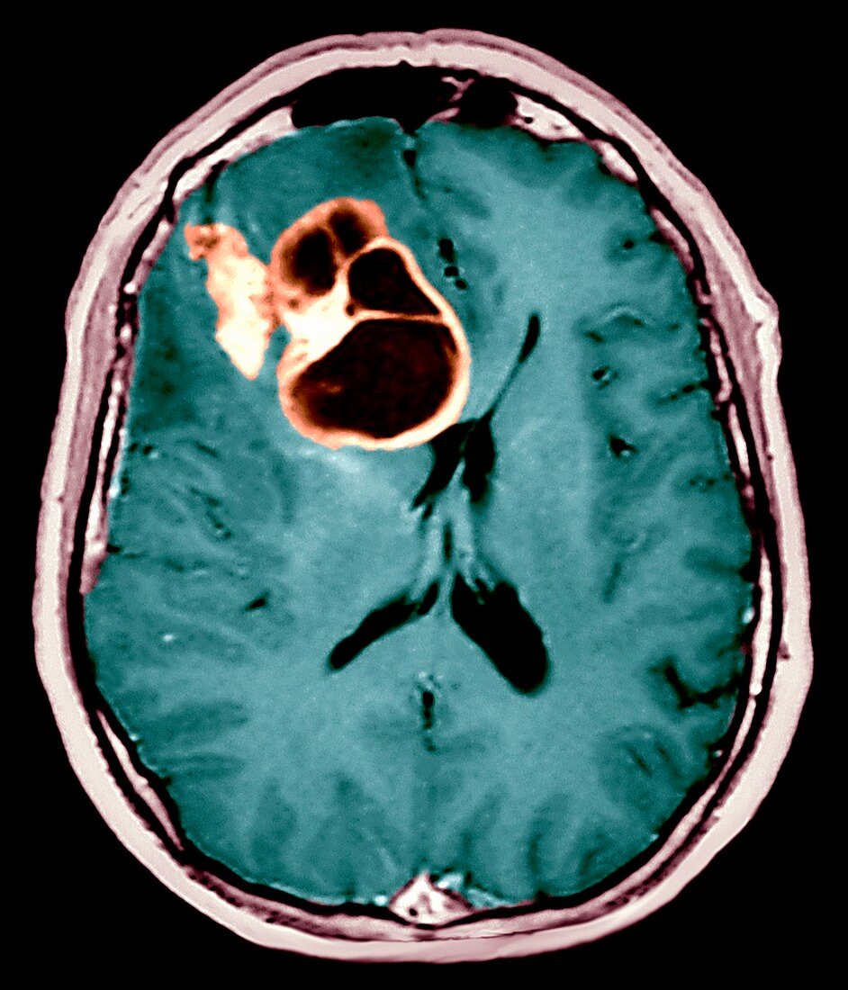 Brain cancer,MRI scan