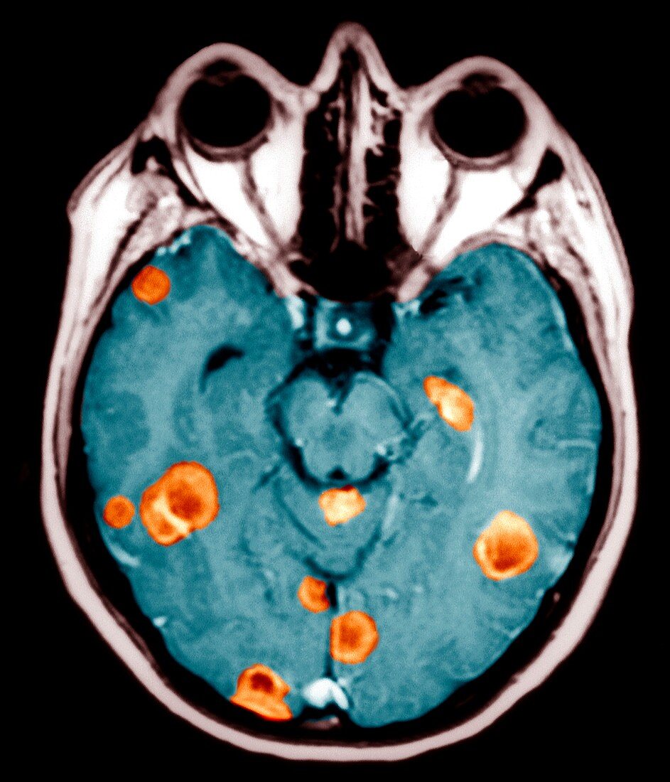 Brain cancers,MRI scan
