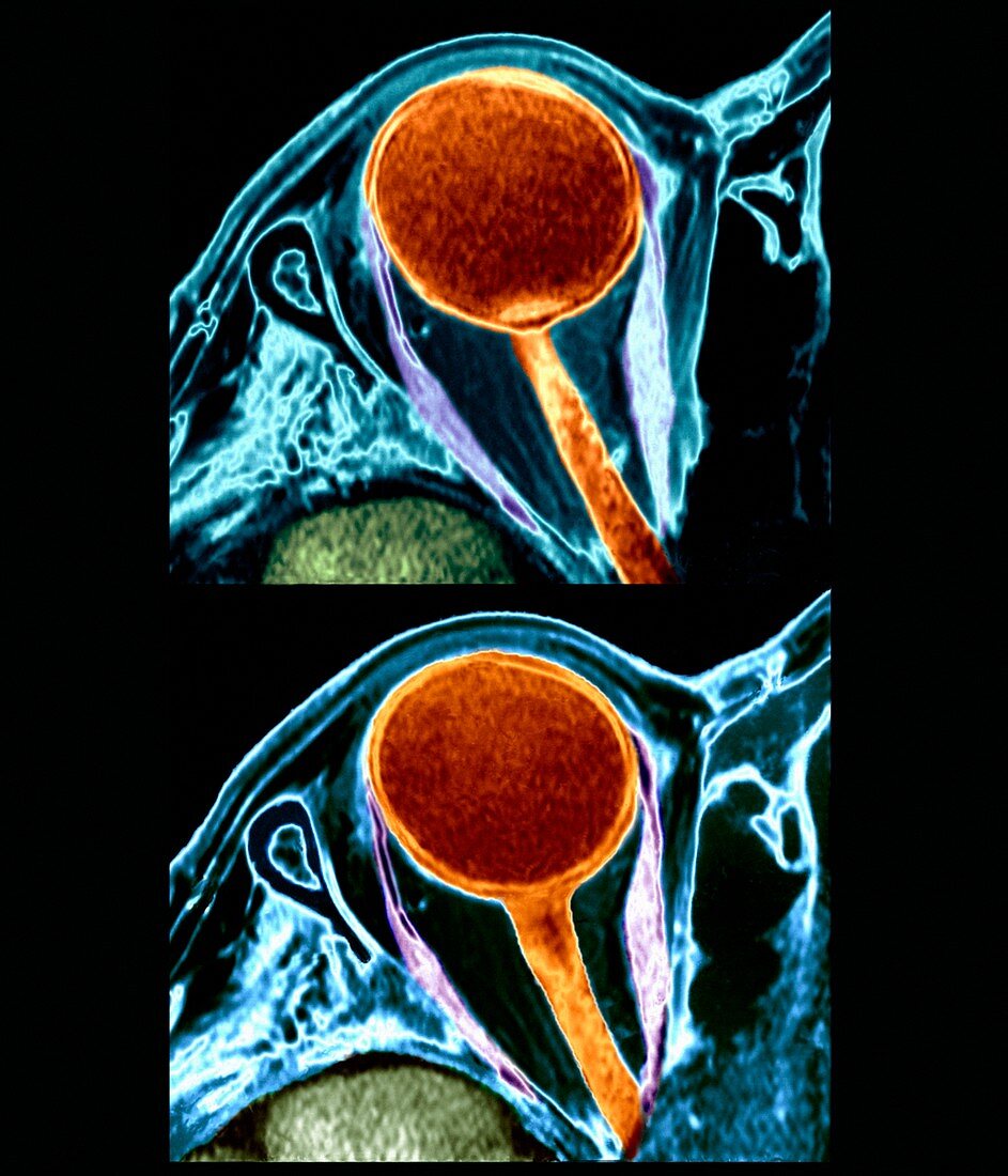 Eye cancer,MRI scan