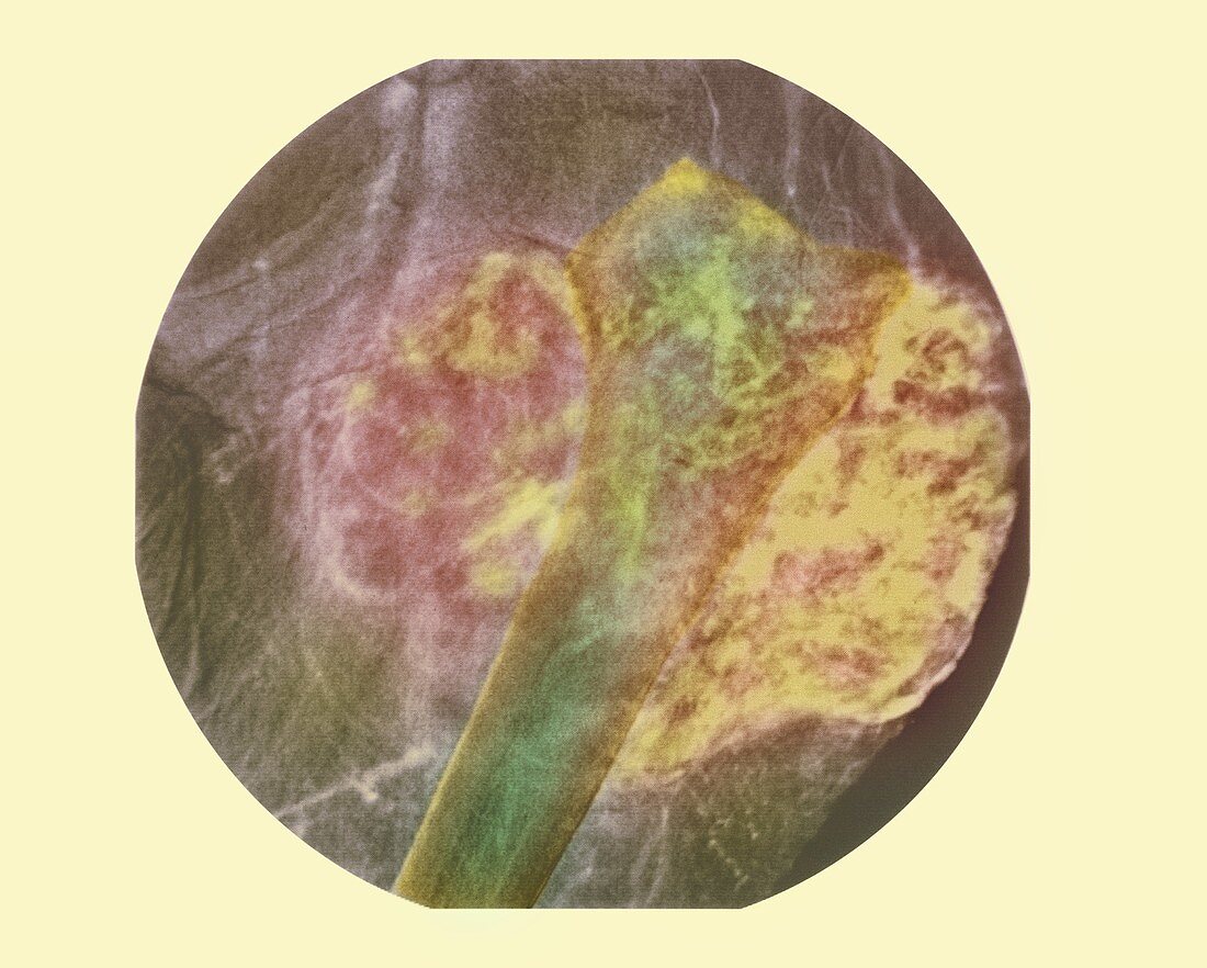 Bone cancer blood supply,X-ray