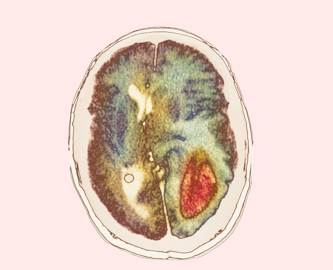 Glioma brain cancer growth,CT scan