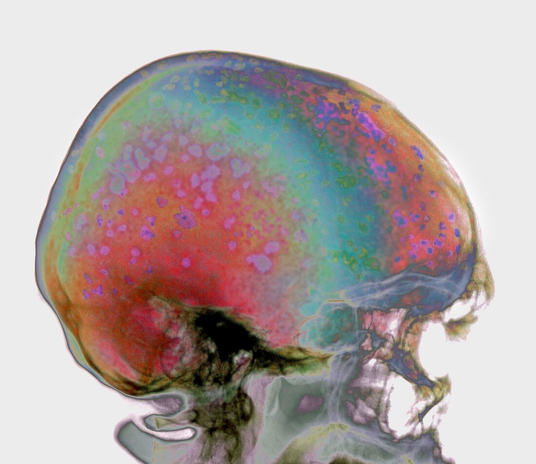 Blood cell cancers,X-ray