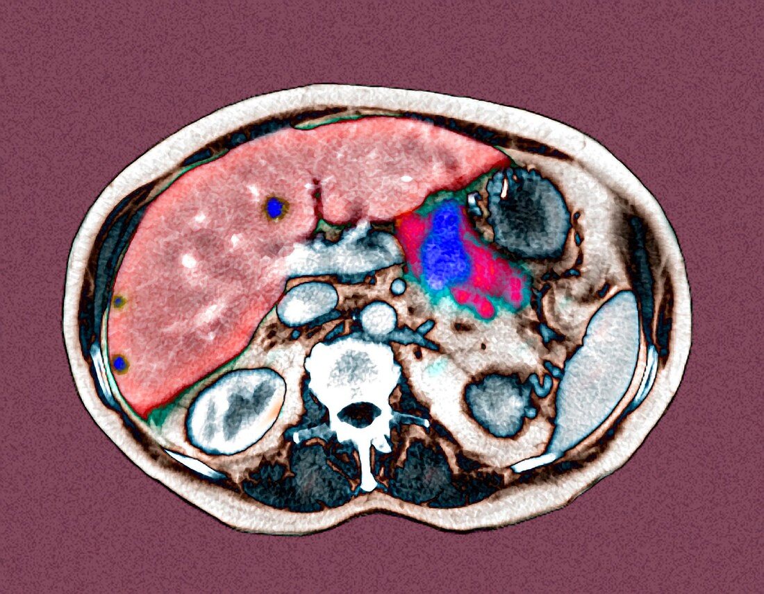 Metastatic pancreatic cancer,CT scan