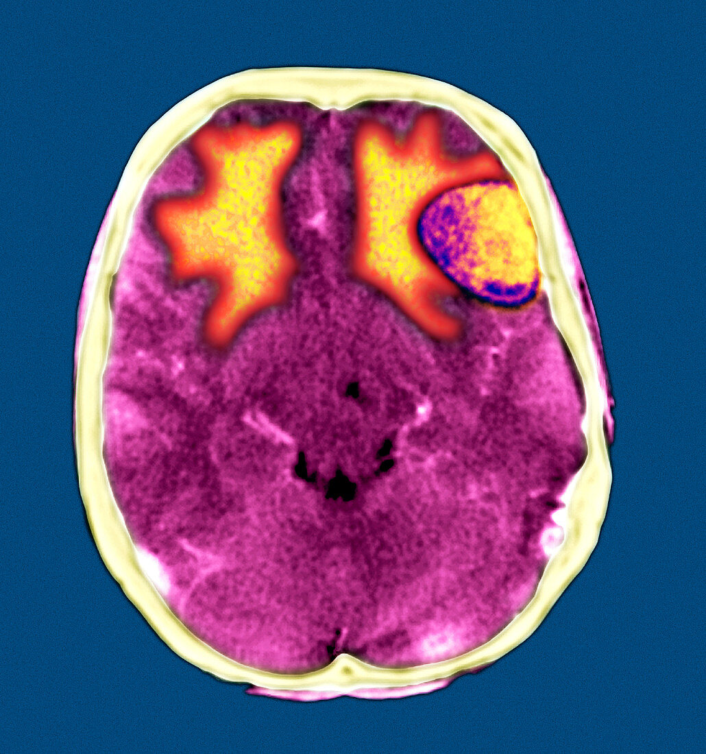 Secondary brain cancers,CT scan