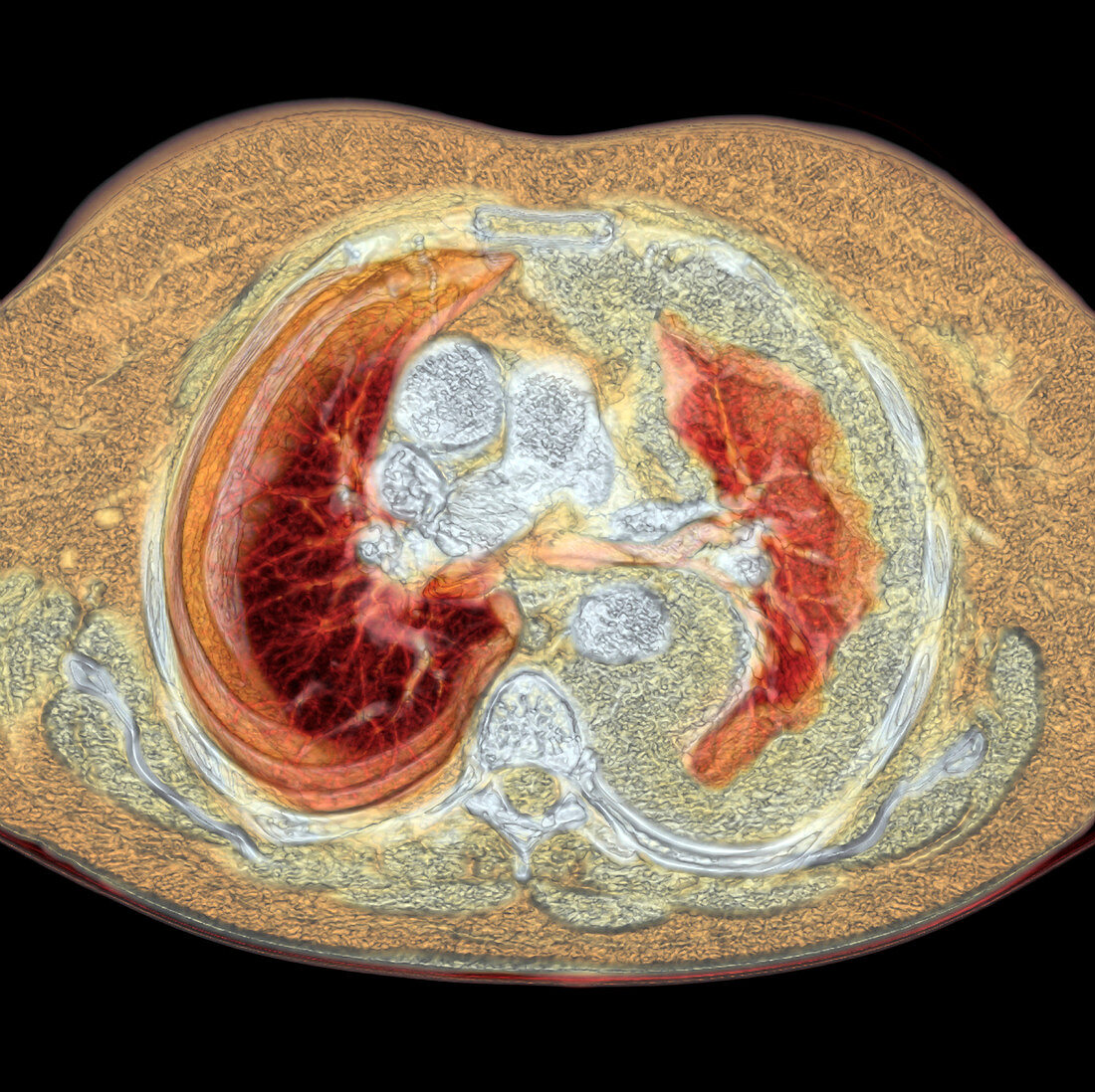 Lung cancer,CT scan