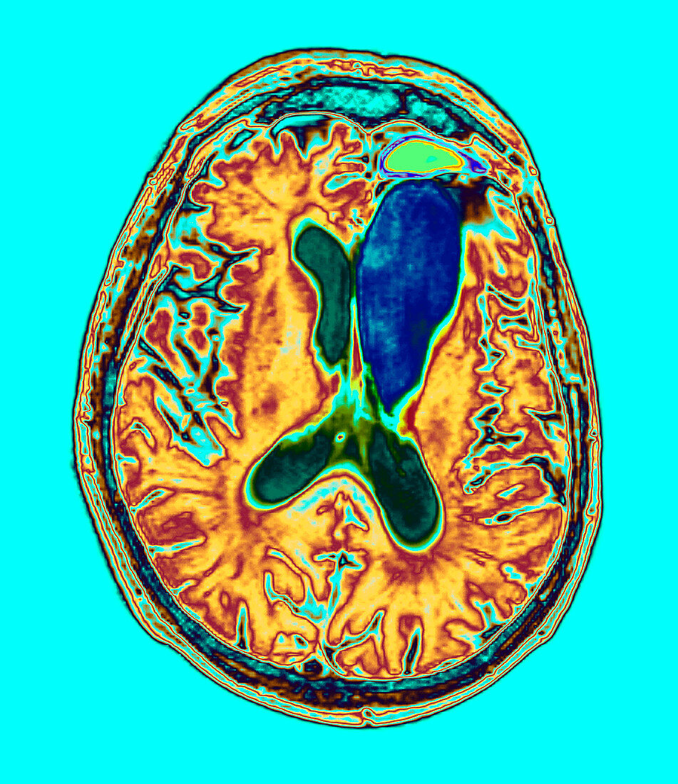 Brain cancer treatment,MRI scan