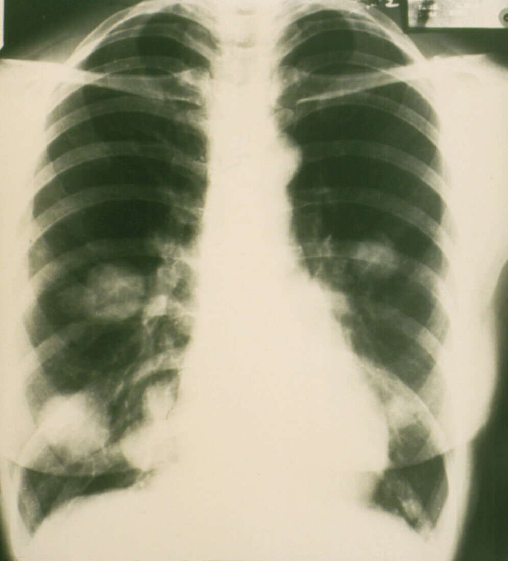 Chest x-ray showing cancer tumours in lungs