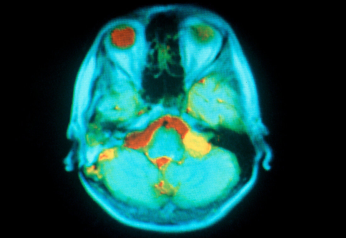MRI image of an acoustic neuroma tumour