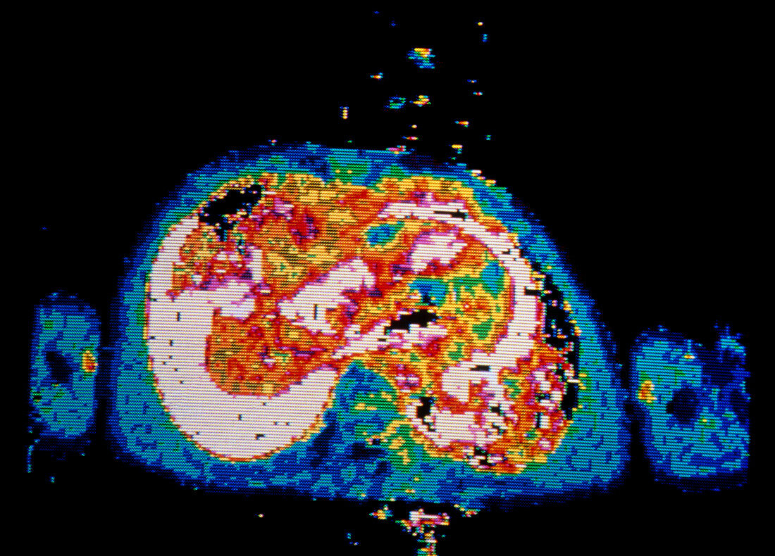 NMR scan of patient with Hodgkin's disease