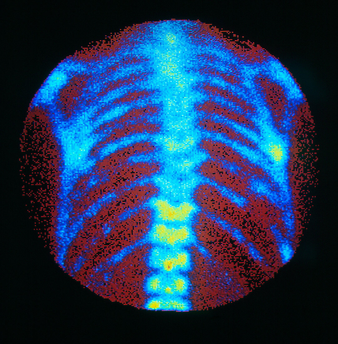 F/col gamma bone scan showing secondary cancer