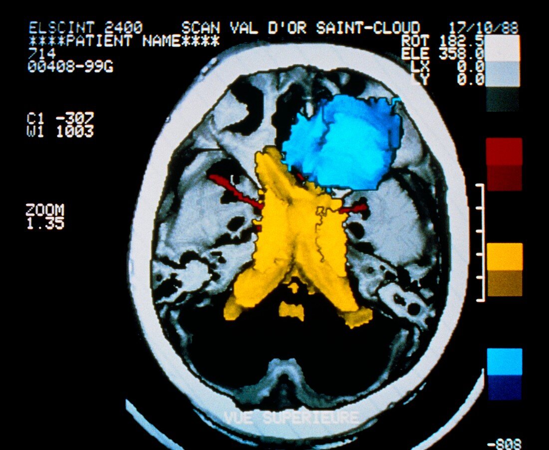 False-colour 3-D CT brain scan showing meningioma